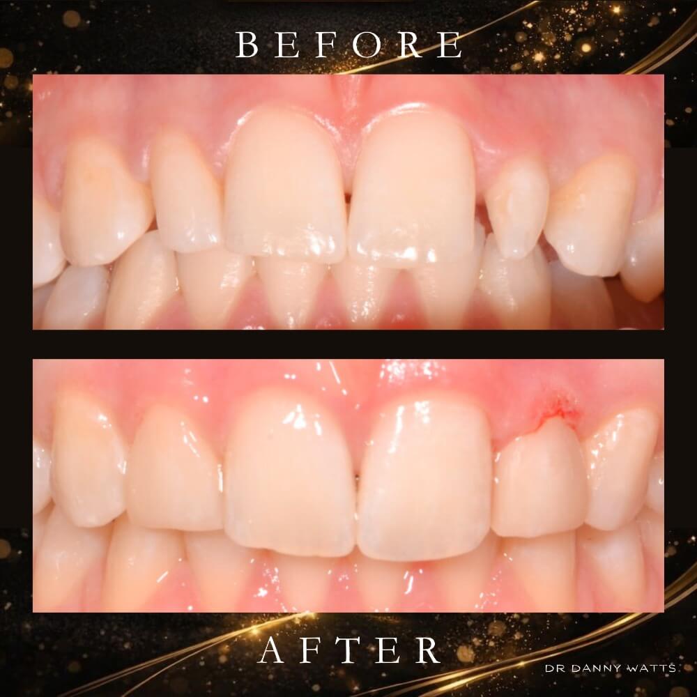 Before & After Results